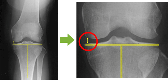 変形性膝関節症の主な症状